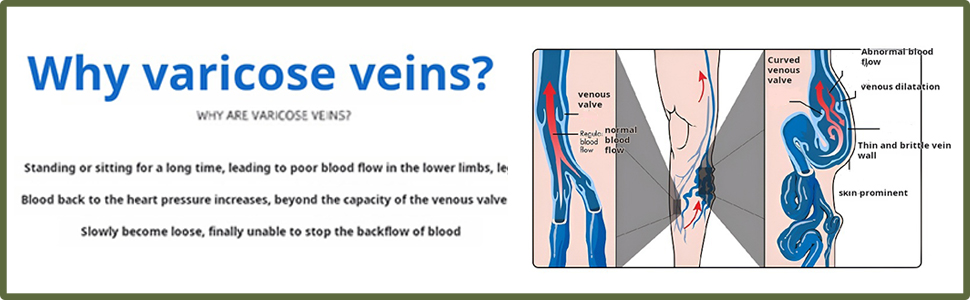 Why do you get varicose veins?