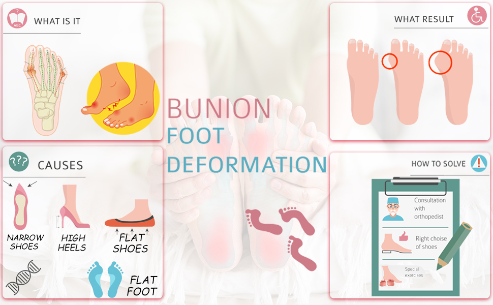 Bunion foot
