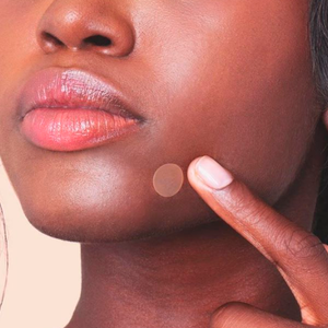 Pimple patches