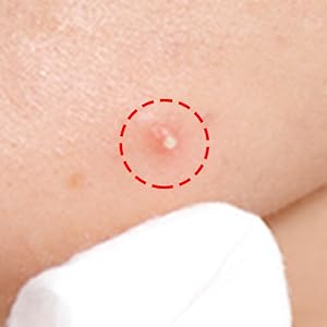 acne dots micropoints