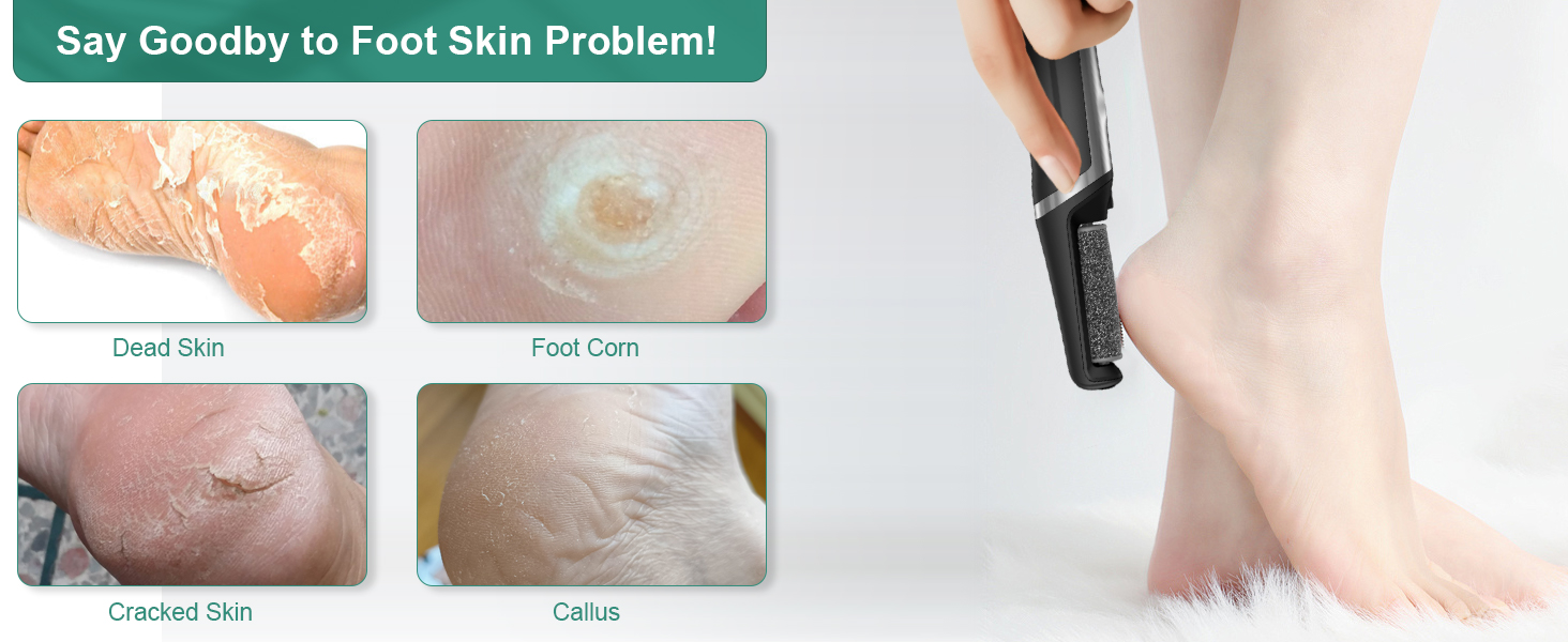 electric foot file callus remover