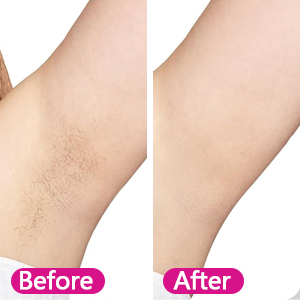 hair removal