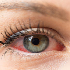 Eye drops for redness