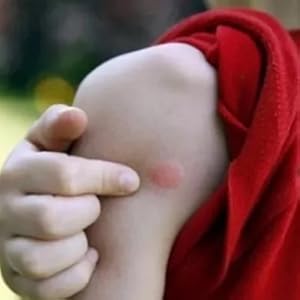 Insect bite,kids hammock