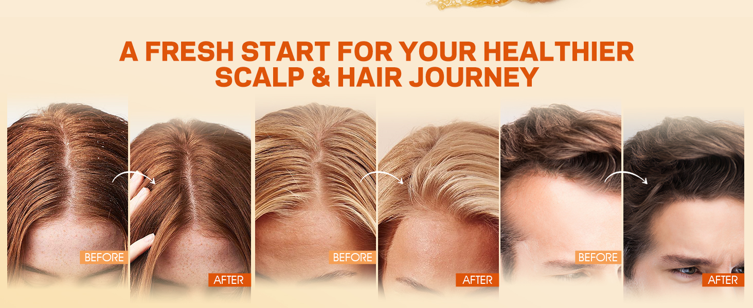 scalp scrub for dandruff removal