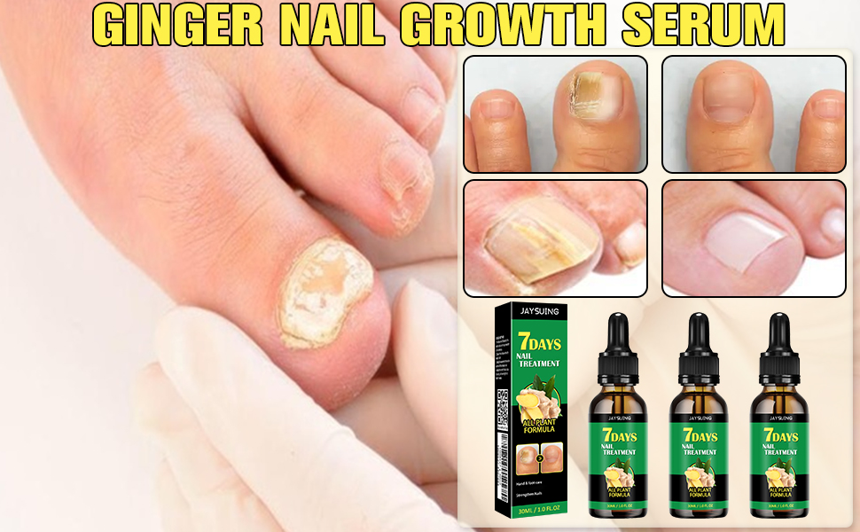 Ginger Nail Treatment