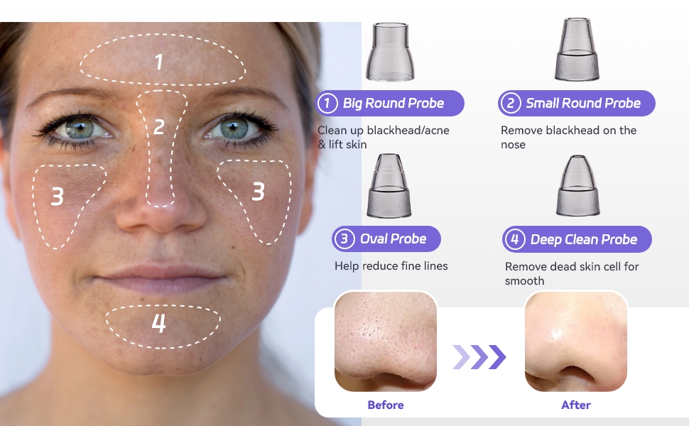 Blackhead Remover Pore Vacuum, Blackhead Extractor Pore