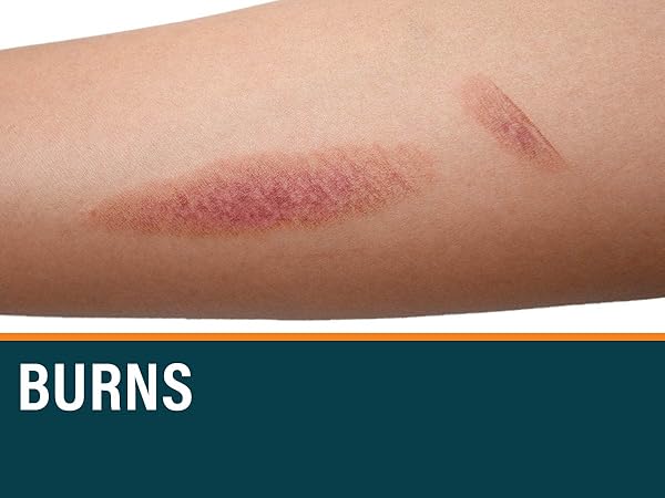 Burn