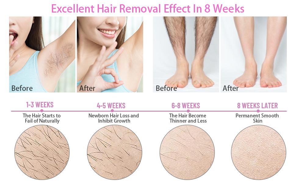 IPL hair Removeral
