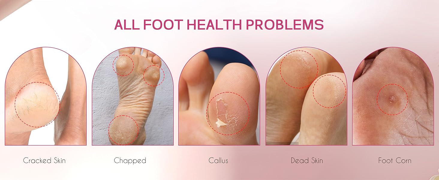 Electric Callus Remover for Feet