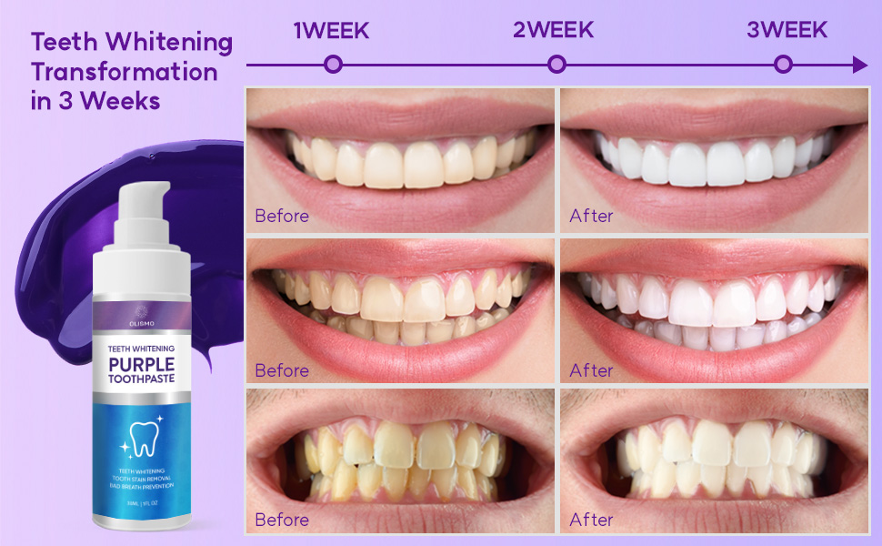 Teeth Whitening 
