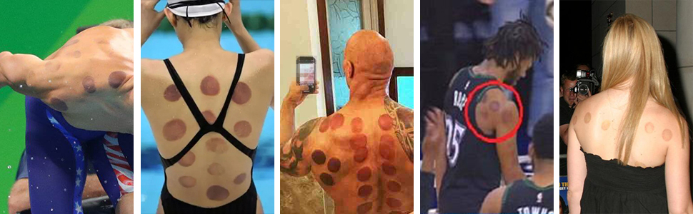 electric cupping