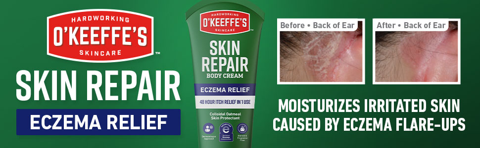 Skin Repair Eczema Relief moisturizes irritated skin caused by eczema flare ups