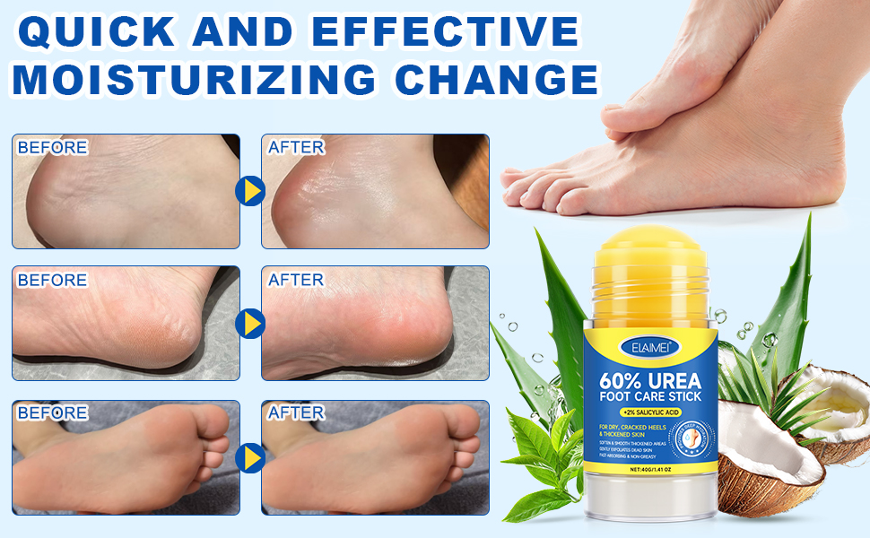60% Urea with 2% Salicylic Acid Urea Foot Care Stick