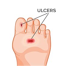 tegaderm 4x4 3/4 absorbent stick butterfly bandages medical gauze wound wash foot ulcer pads