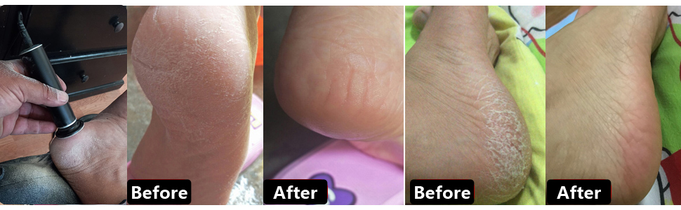 electric callus remover for feet