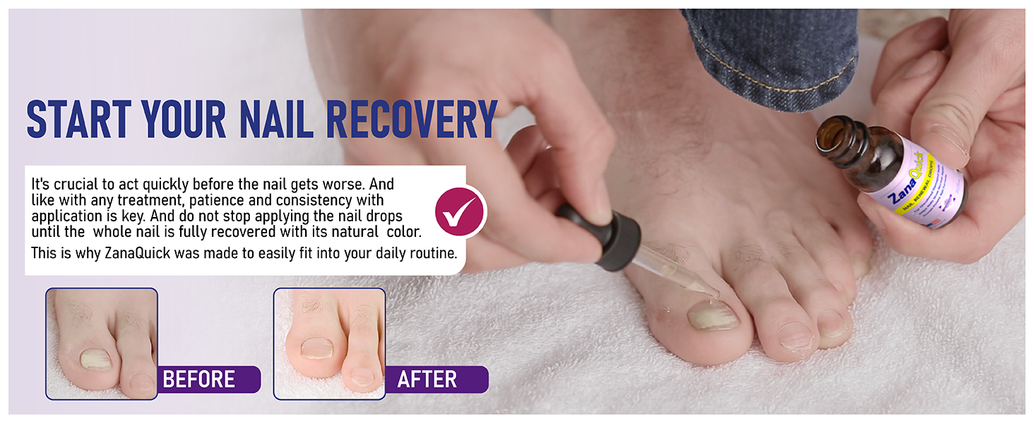 pomada para hongos en los pies terbinafina crema para hongos tratamiento para uñas con hongos crema