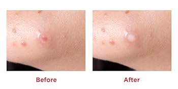 Tea Tree Clear – Dot Patch