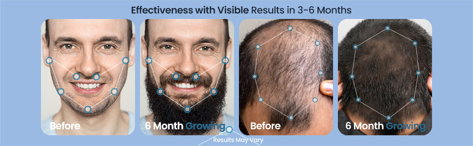 minoxidil for men beard