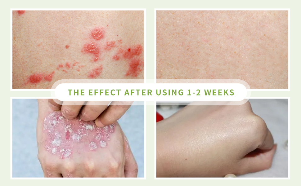 Best Cream For Boils Cosmetic Surgery Tips