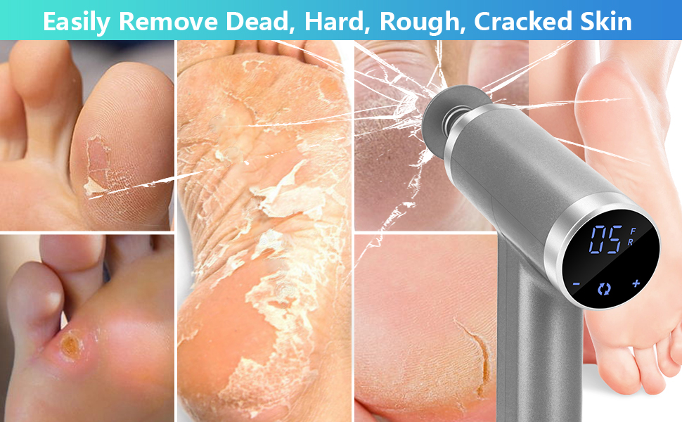 electric callus remover for feet