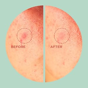 Tea Tree Clear – Dot Patch