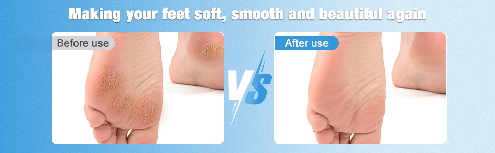 Callus remover