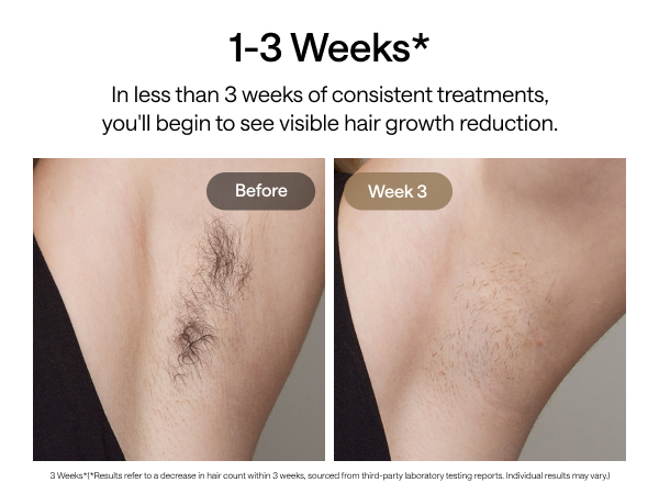 脱毛・除毛 HIKARI BEAUTY3 HIKARI BEAUTY 3 脱毛器