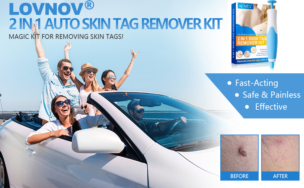 Auto Skin Tag Remover Kit, LOVNOV Painless Skin Tag Removal Tool, Mole - Skinfinity Skin Tag Remover Where To Buy