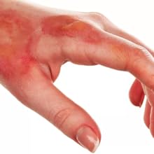 Burn from boiling water