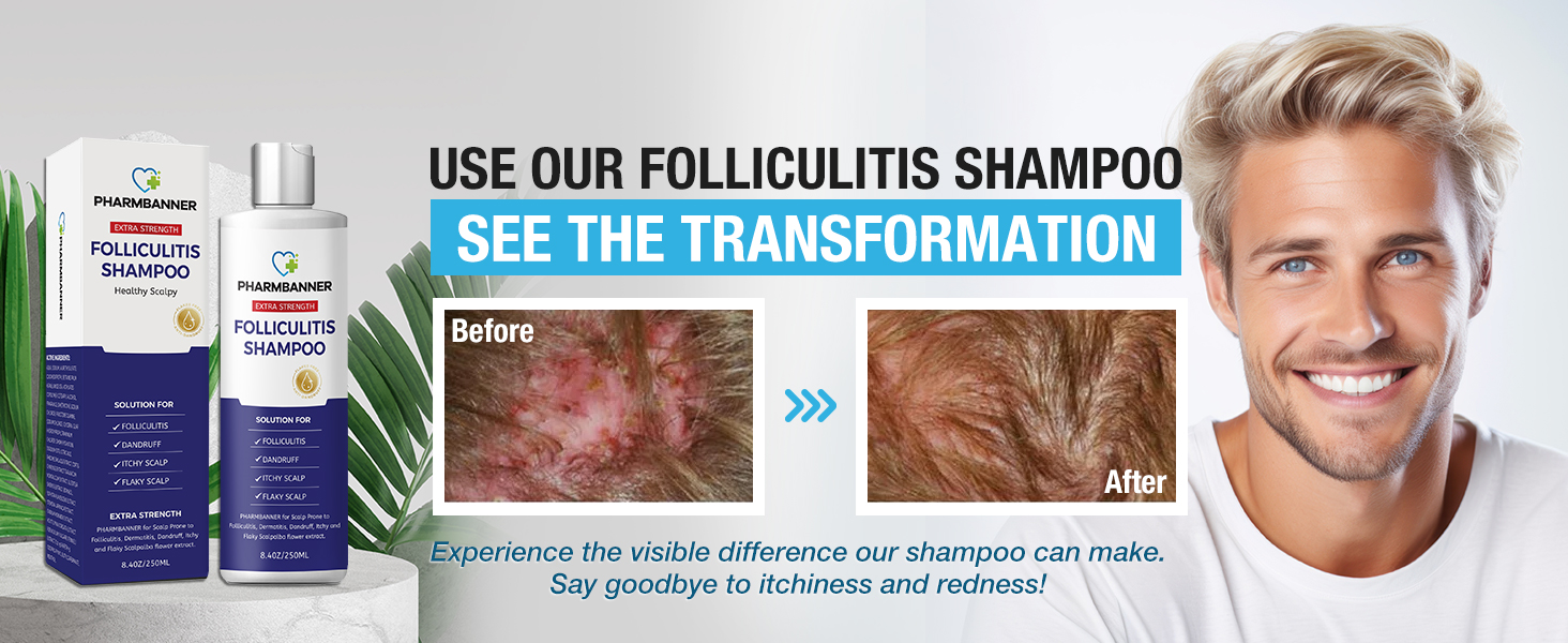 PHARMBANNER AntiFungal Shampoo for Folliculitis