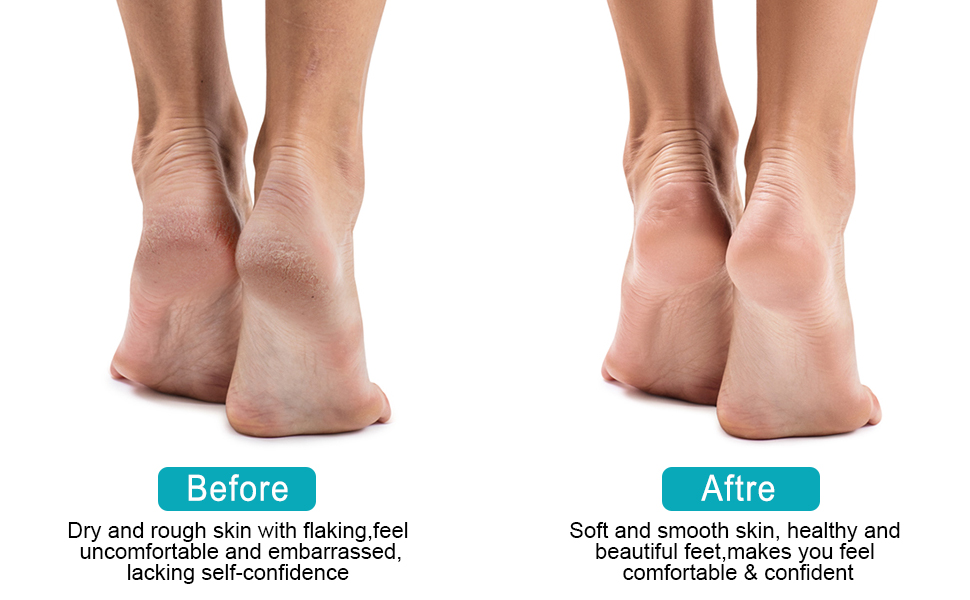 MYCARBON Electric Foot File Waterproof Hard Skin Remover Pedicure Set Rechargeable Feet Callus