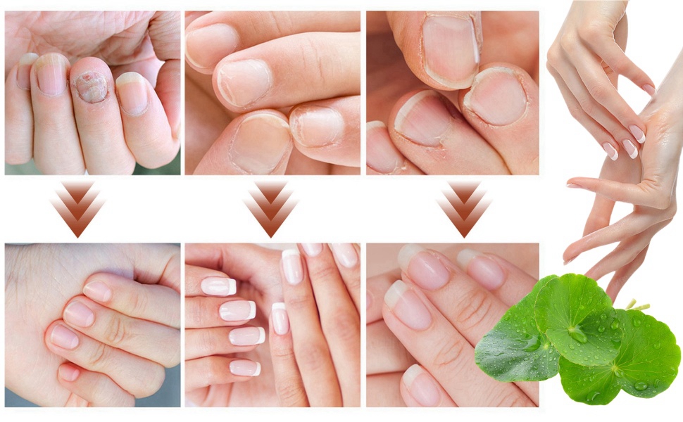 Serum Nail Repair Serum Nail Strengthener for Damaged Nails Nail Hardener for Growth and Strength