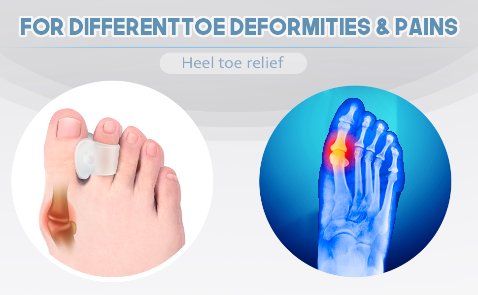 MHSY Gel Toe Separators for Overlapping Toes, 4PCS Bunion Correctors