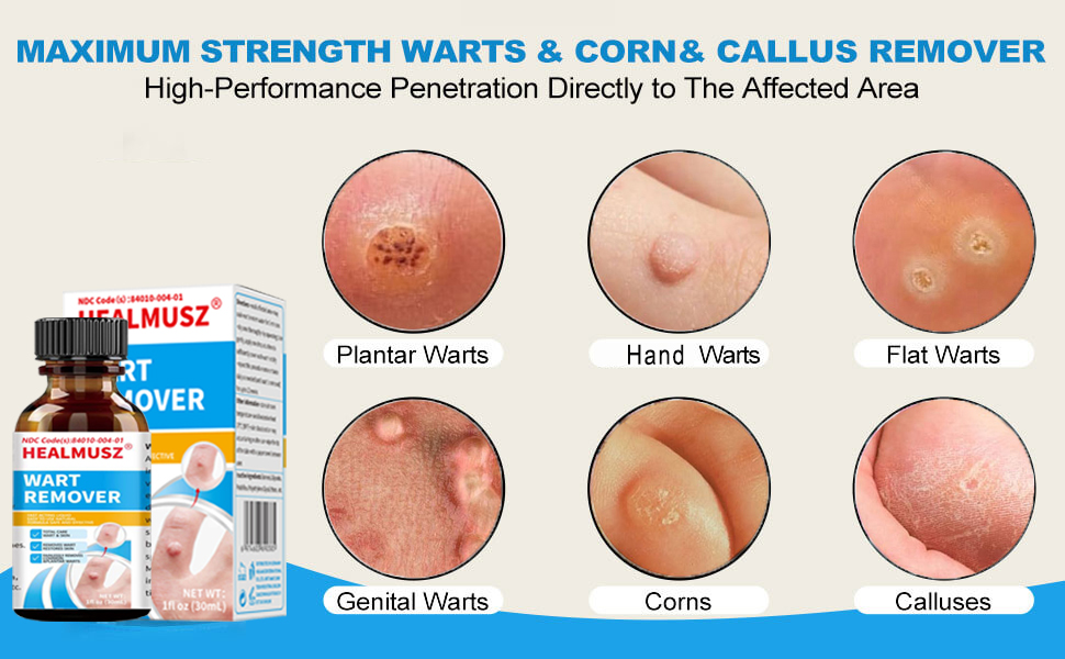 Wart Removal