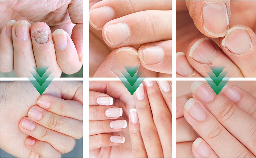 Ginger Nail Treatment