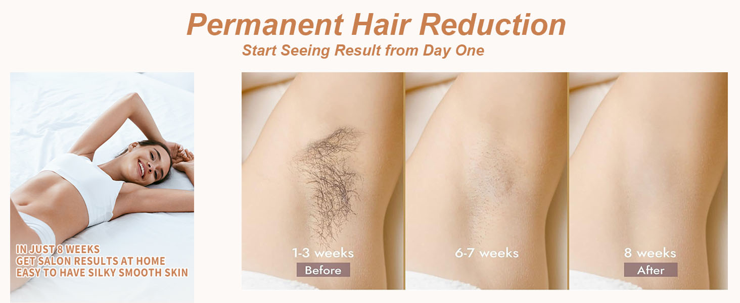 Permanent Hair Reduction