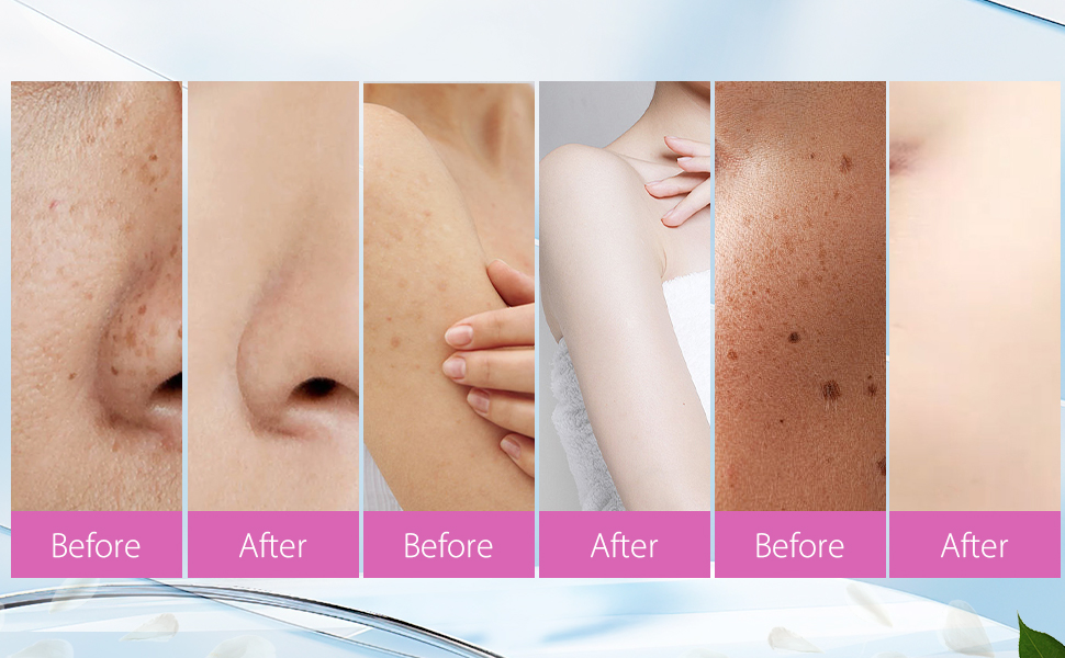 anti pigment cream