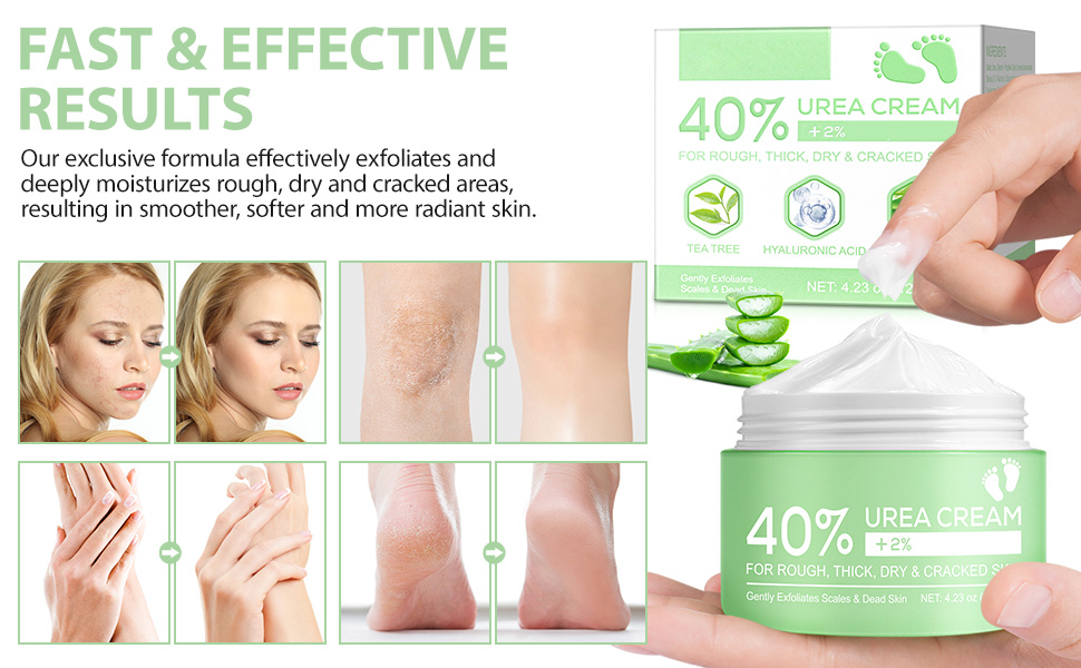 Urea Cream 40 Percent