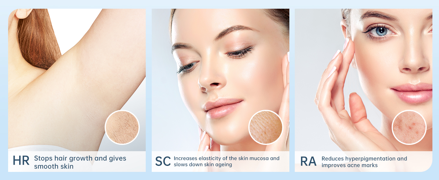 laser hair removal
