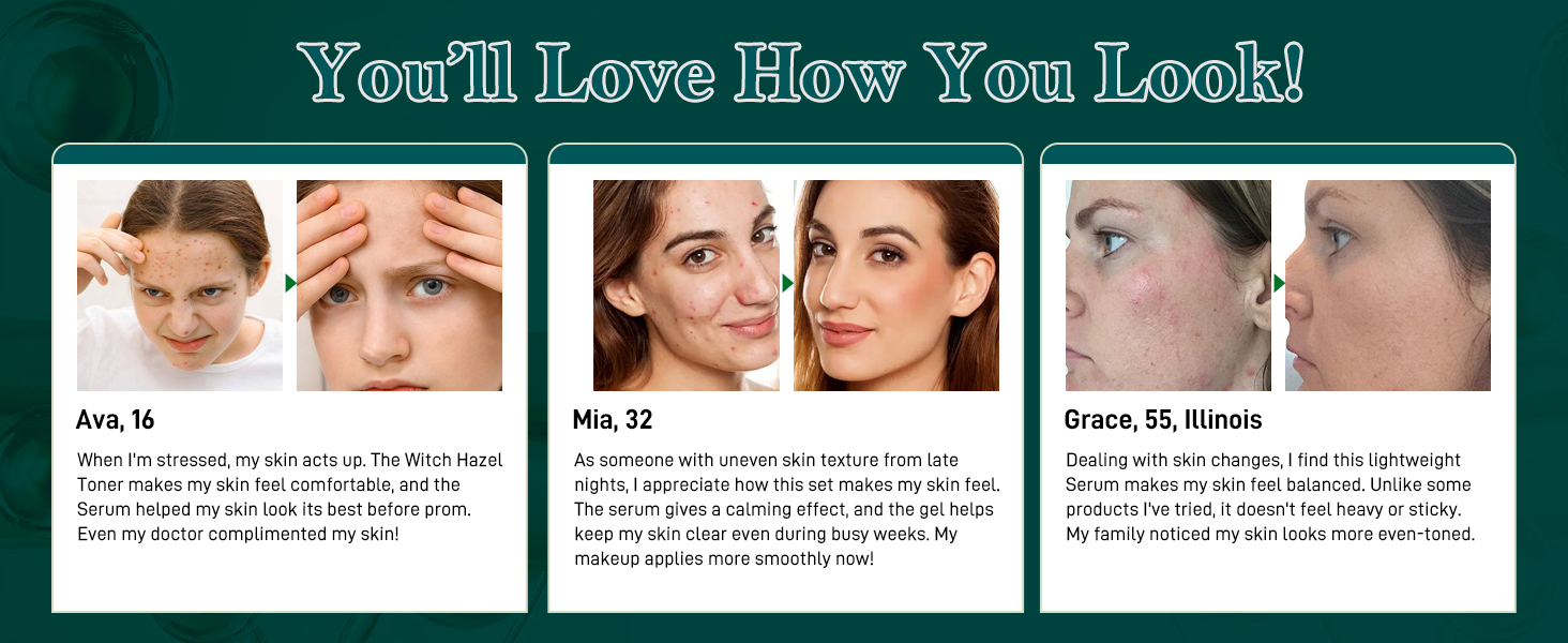 Acne Free 5-Step Acne Treatment Kit