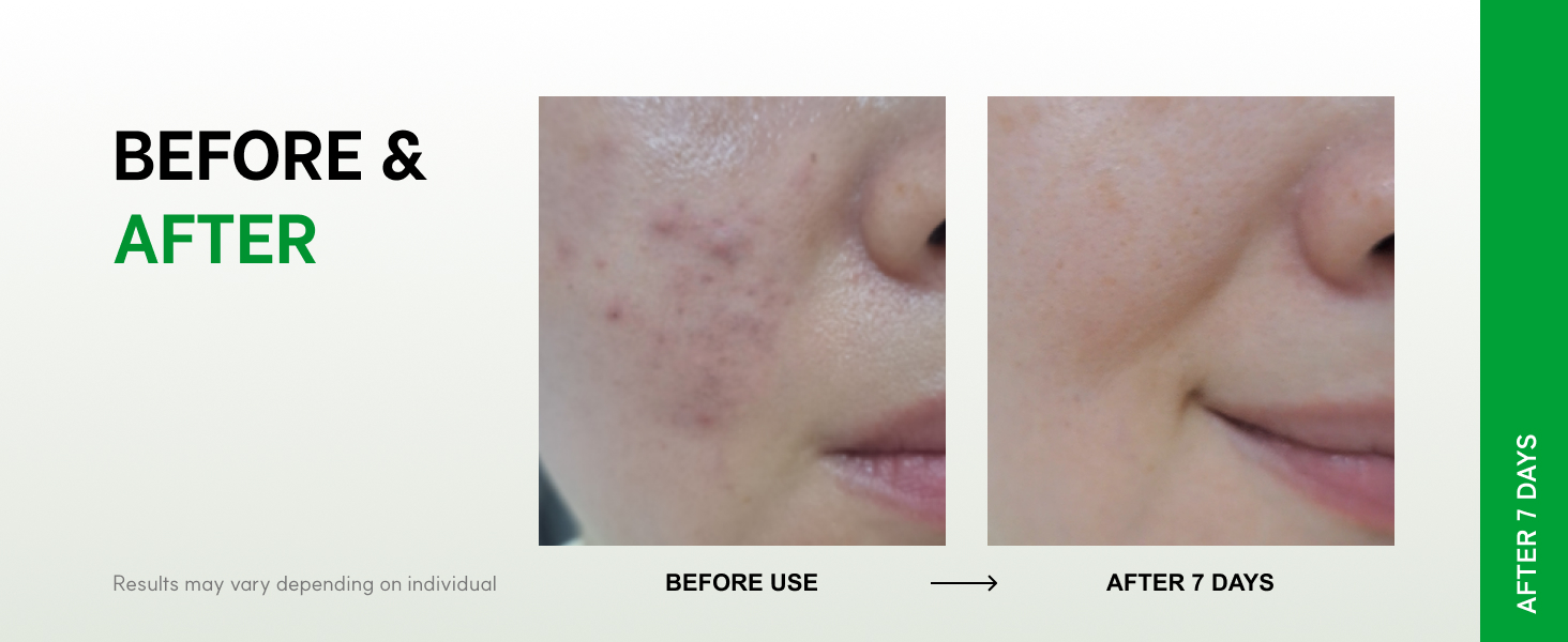 Centelsome 5X Soothing Cream for Visible Results in 7 Days on Redness, Blemishes, and Irritation
