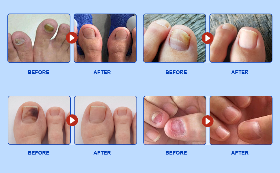 FUNGAL NAIL PATCHES