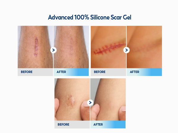 100% Silicone Scar Gel Scar Cream M7-1