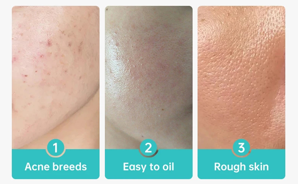 Azelaic Acid Acne Cream With Aloe Extract