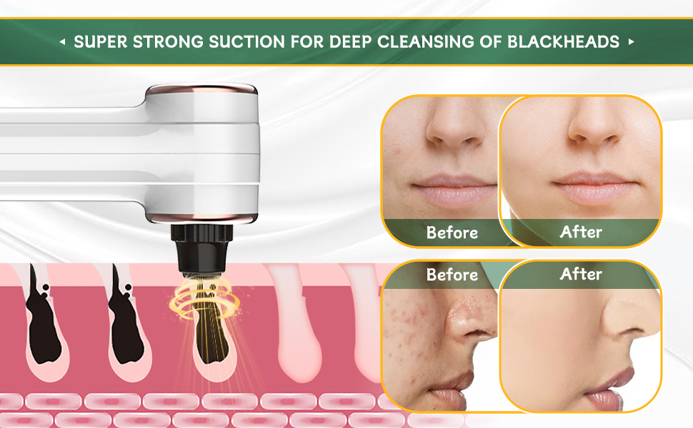 BENTFINE 2024 Newest Blackhead Remover Vacuum, 2 in 1 Pore Vacuum