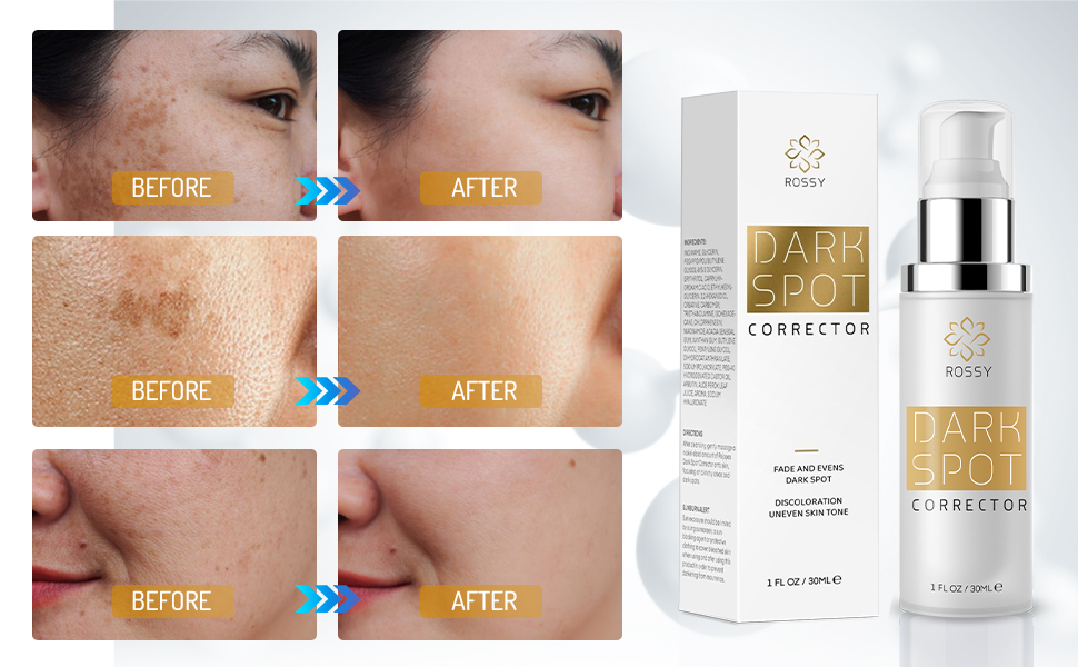 Dark Spot Remover for Face and Body: Dar... 20 dark 4