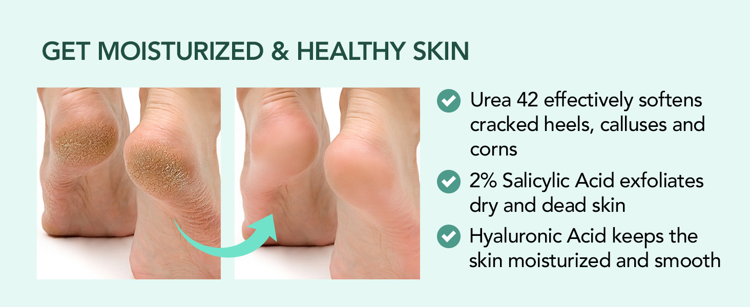 urea cream 40 percent for feet gel
