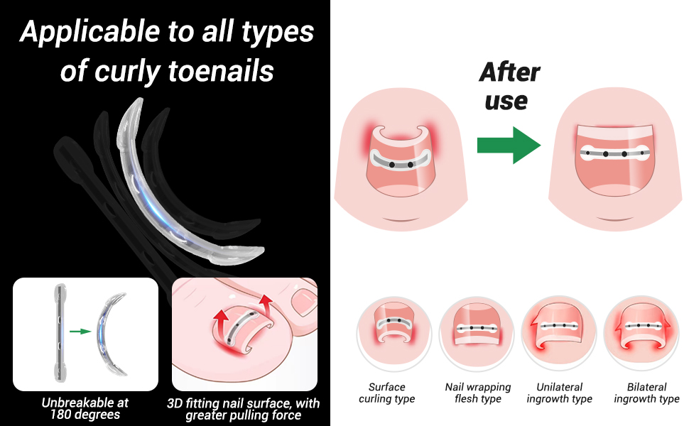Reieset Titanium Alloy Ingrown Toenail Treatment,Nail Tools