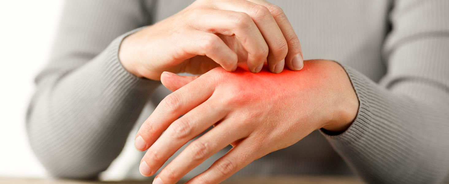 Eczema Cream